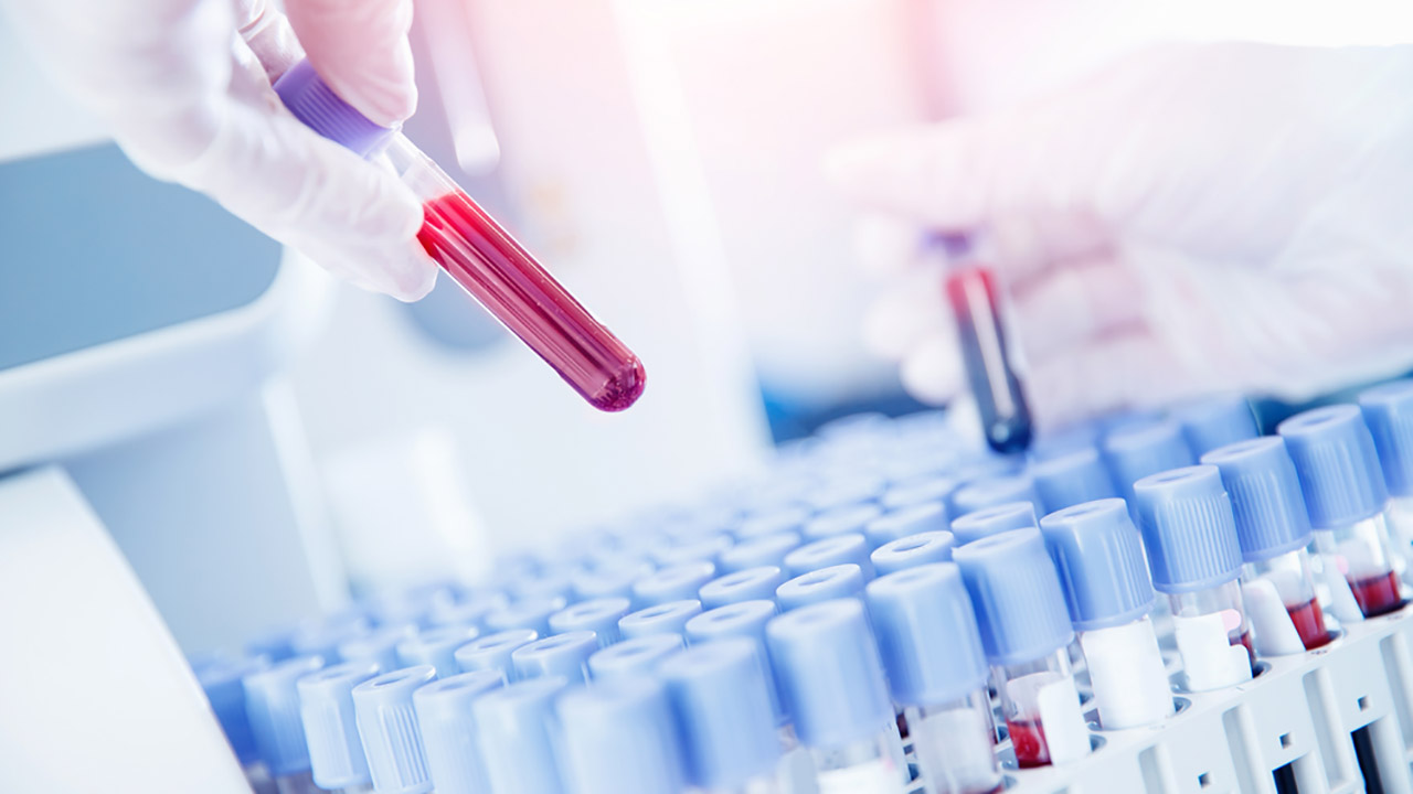 Badania krwi w kierunku choroby Alzheimera: osiągnięcia zmieniające podejście do leczenia tej choroby.