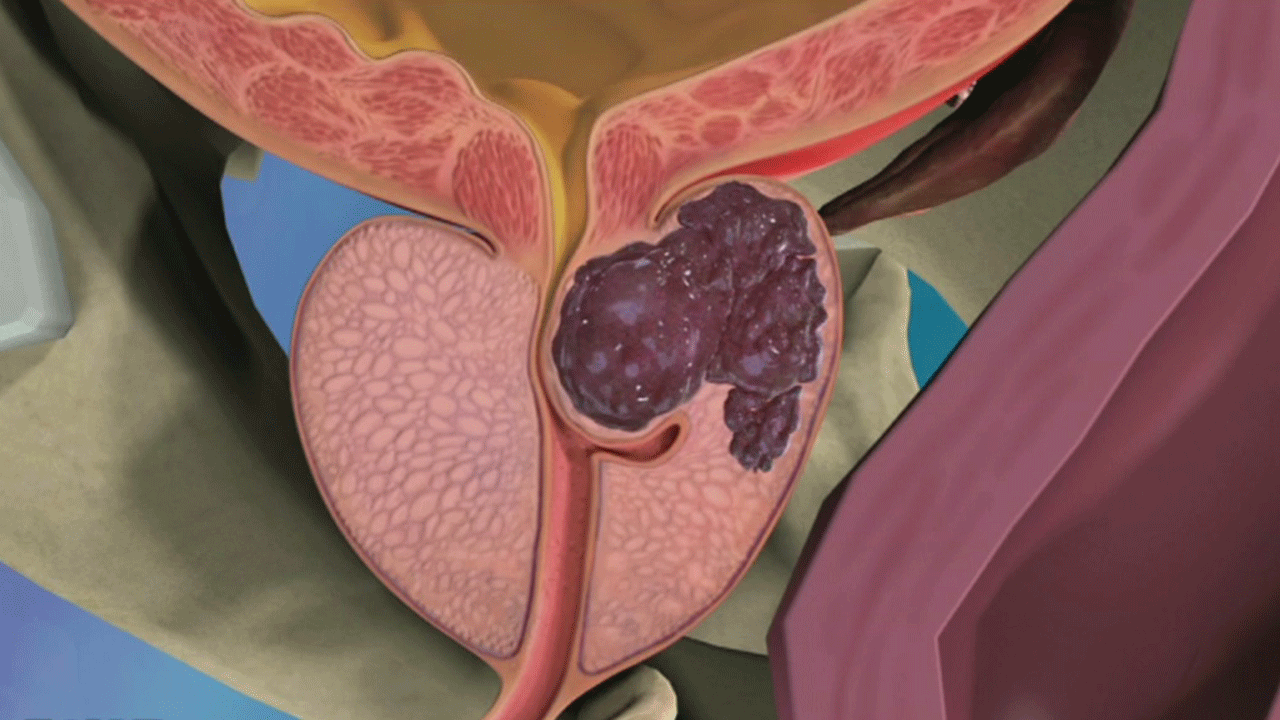 Częstotliwość ejakulacji jest jednym z kluczowych czynników profilaktyki raka prostaty.