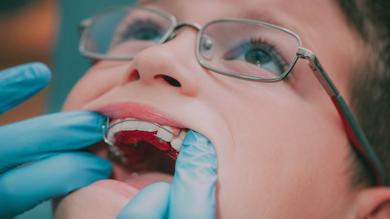 „Epidemia krzywych zębów”: większość dzieci i nastolatków wymaga leczenia ortodontycznego.