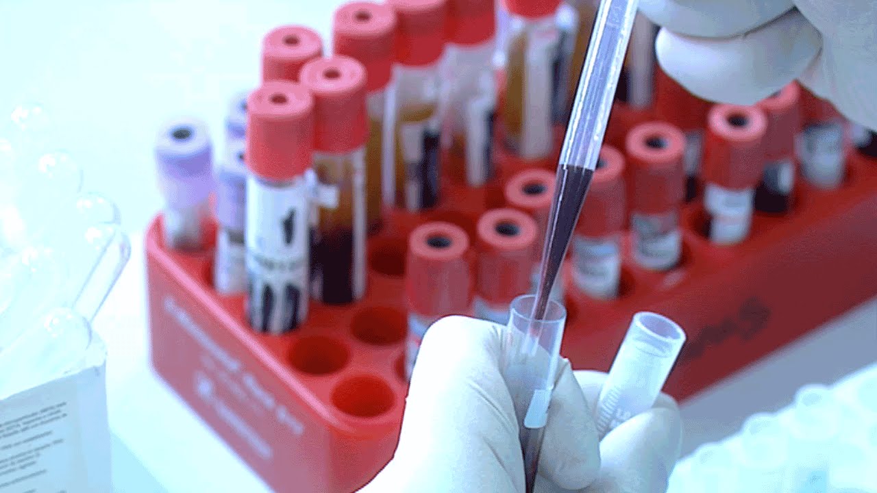 Spersonalizowane dostosowanie biomarkerów: przełom, który może zmienić przyszłość diagnostyki choroby Alzheimera.